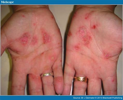 severe eczema on hands - pictures, photos