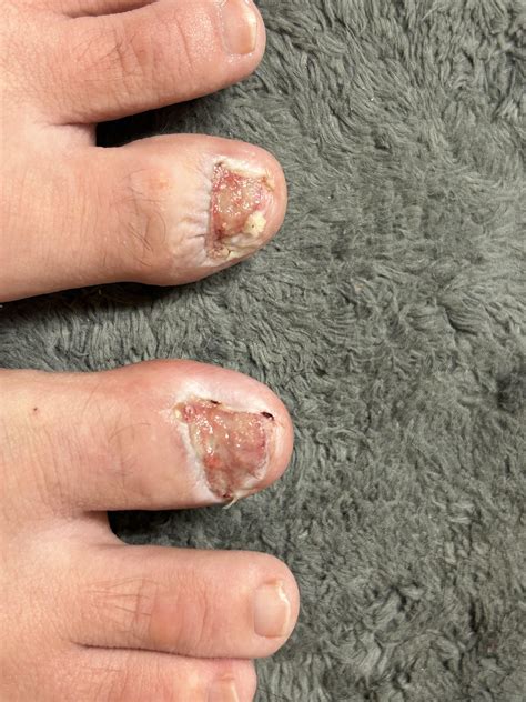 Ingrown Toenails