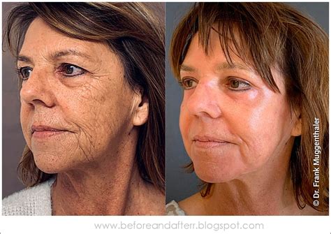Peeling Fenol Antes E Depois - Peeling De Fenol Atenuado Antes E Depois - RETOEDU