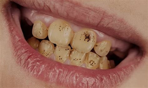 What causes black spots on the teeth?