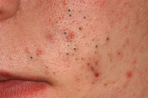 Different Types of Pimples and How to Tackle Them