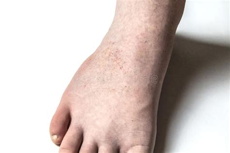 A Red Rash on the Foot of a Male Against Background. CloseUp a Part of ...