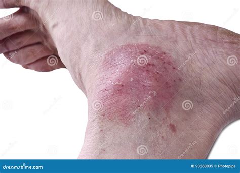 Psoriasis, Skin Disease Royalty-Free Stock Photography | CartoonDealer.com #93260525