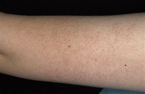 Queratosis pilar foto – 110 imágenes / fotodiagnostico.com