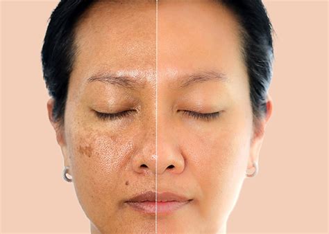 skin pigmentation  types treatments dr priti shukla