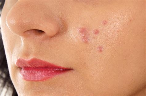 acne papules treatment