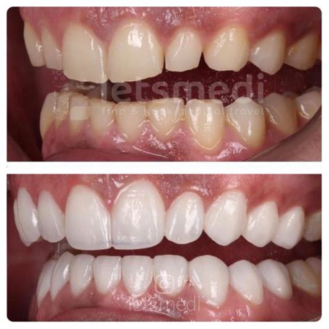 Composite Veneers in Turkey - Letsmedi