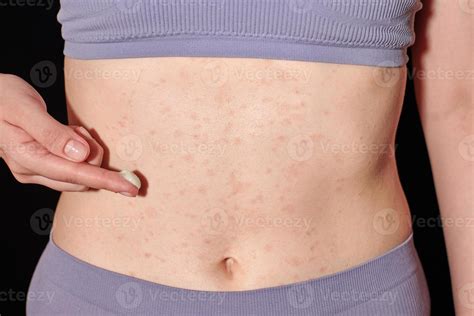 Red allergic rash on belly skin, atopic dermatitis, eczema ...