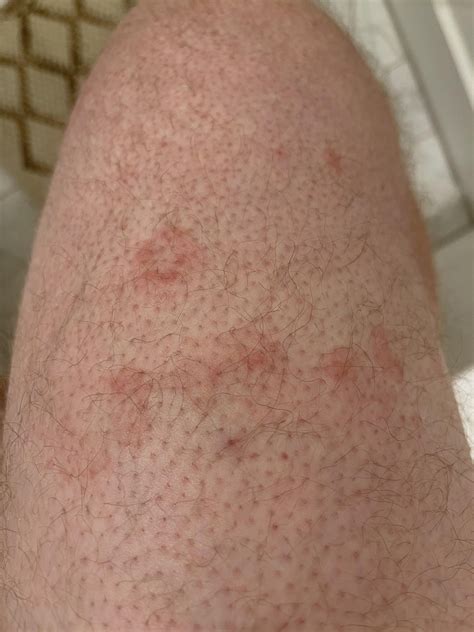 Pityriasis rosea, erythema annulare centrifugum, or nummular eczema