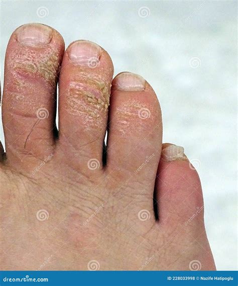 Fungal Calluses on the Toes, Itchy Foot Diseases, Fungal Disease on the