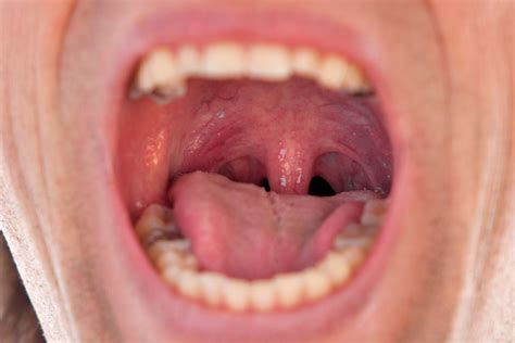 Wunde im Mund - Diagnose, Ursachen und Behandlungsmethoden