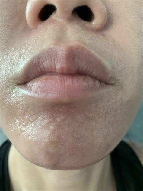 Sebaceous Gland Hyperplasia On Lips | Lipstutorial.org