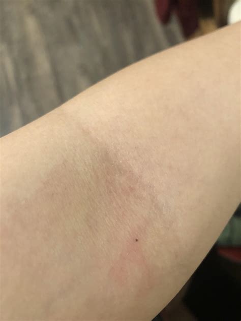 Is this a tick bite? Memphis, Tennessee, USA - La Vie Zine