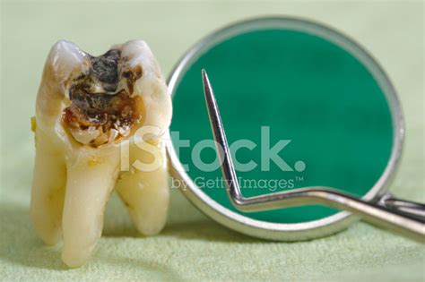Extracted Tooth Stock Photo – Royalty-Free Images | FreeImages