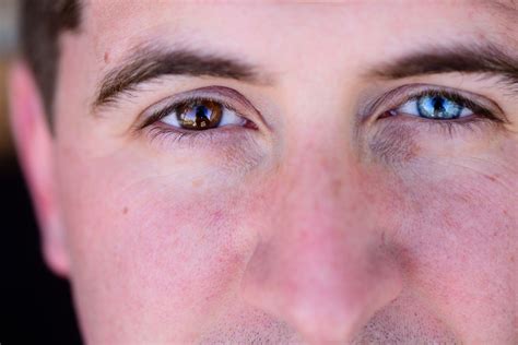 heterochromia    colored eyes