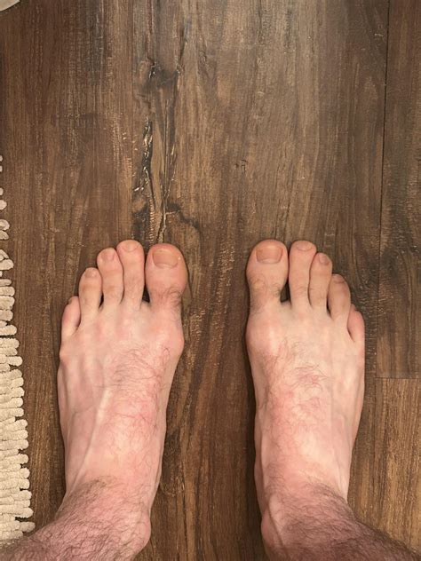 Wondering if I have a bunion on left big toe.. : r/bunions