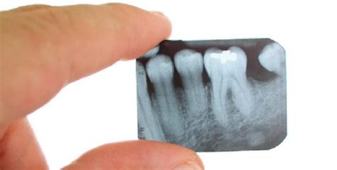 Постоянные зубные пломбы - Энциклопедия стоматологии DentalMechanic.ru