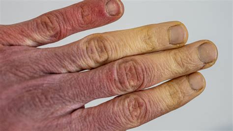 frostbite symptoms  treatment