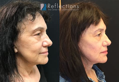 surgical face lift prior    pictures  outcomes