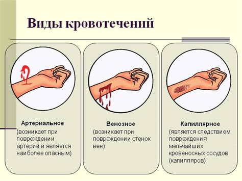 Презентация - Первая помощь при кровотечении