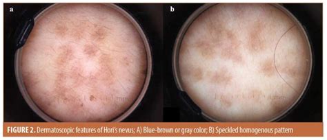 comparative study  dermatoscopic features  melasma  horis