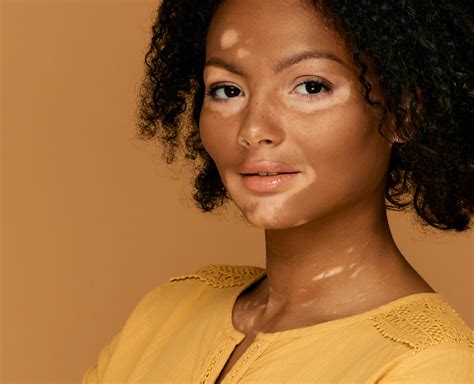 mengenal berbagai jenis penyakit kulit  wajib diketahui