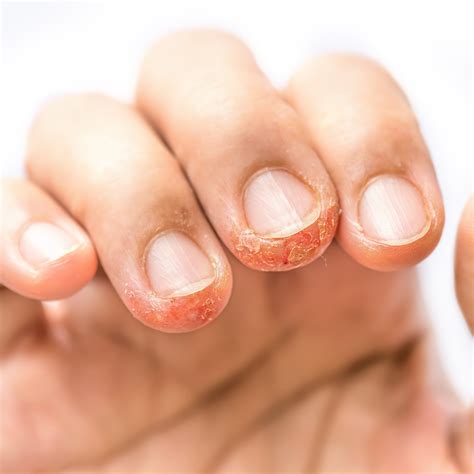 Een allergie voor gelnagels: Hoe ontstaat het en hoe kan je het