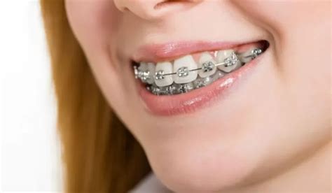 What Types of Braces Should Wear for an Overbite?