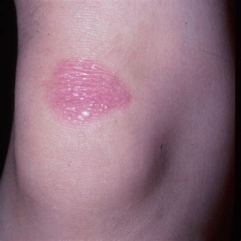 Inherited epidermolysis bullosa | Orphanet Journal of Rare Diseases ...