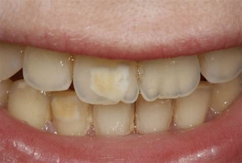 Brown Stains On Teeth – 3 Causes and The Best Solution