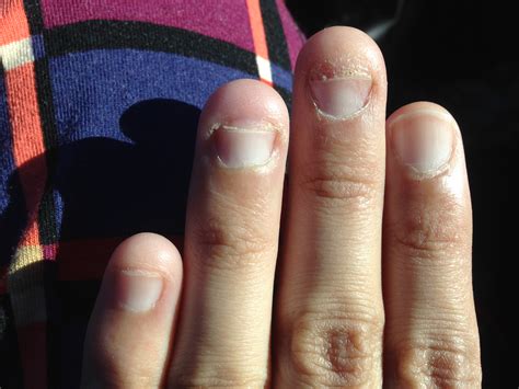 I know you are all nail biters, but I have yet to see someone as bad as