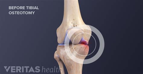 Knee Osteotomy Risks and Complications