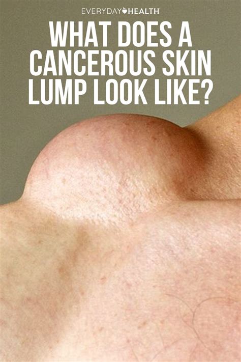 lump   skin printable templates protal