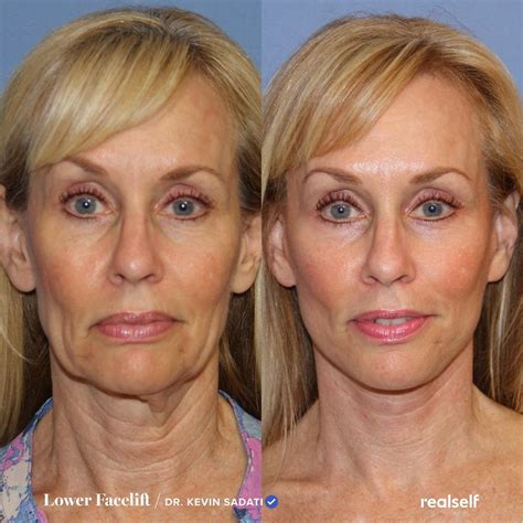 facelift  neck lift whats  difference