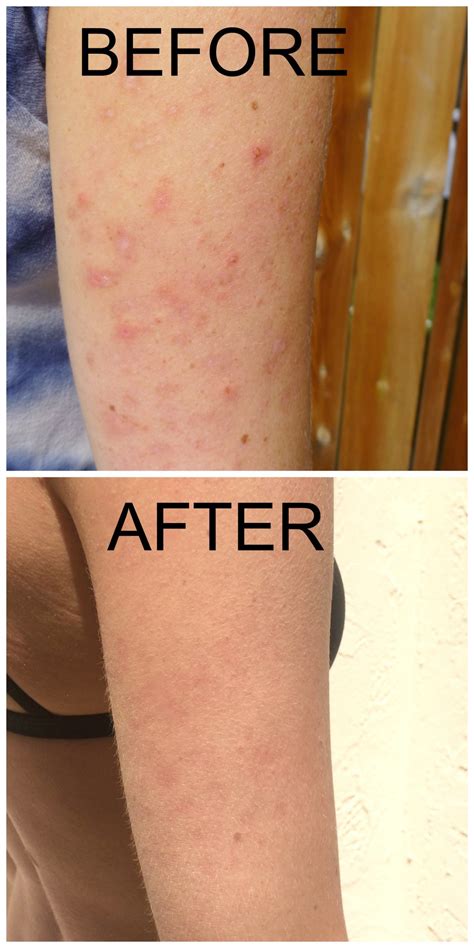 Keratosis Pilaris How To Get Rid Of Bumps On Arms at Steve Michelle blog