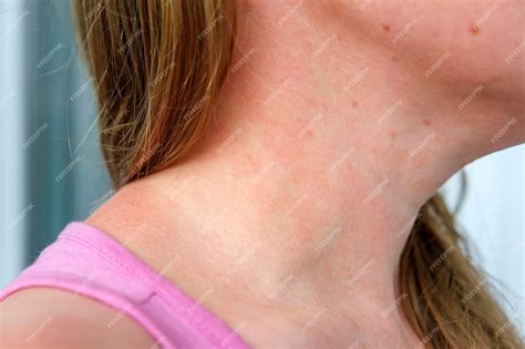 Eczema No Pescoço Tratamento - Dermatite alérgica na pele do pescoço da mulher Doença de pele Doença ...