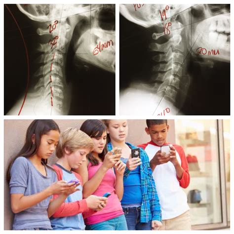 Your Child's Neck posture (cell phones) and How it's Effecting their