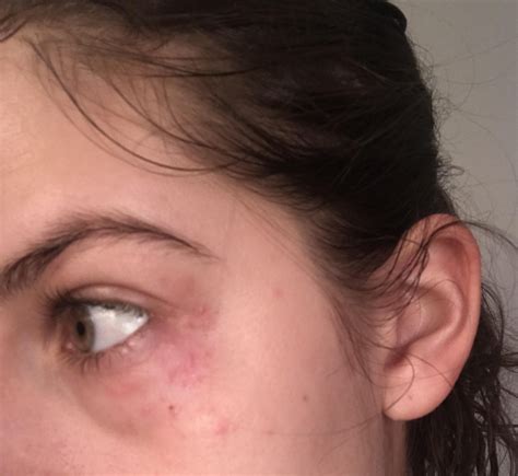 [Skin Concern] what are these red bumps around my eyes? How do I get
