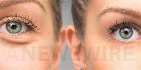 how long does sculptra take to work