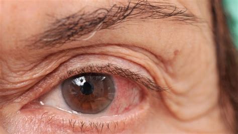 What You Need to Know About Eye Infections and How to Treat Them