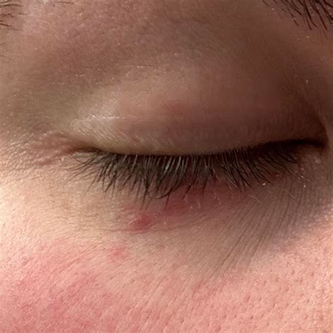 small red bumpsrash  eye   coming