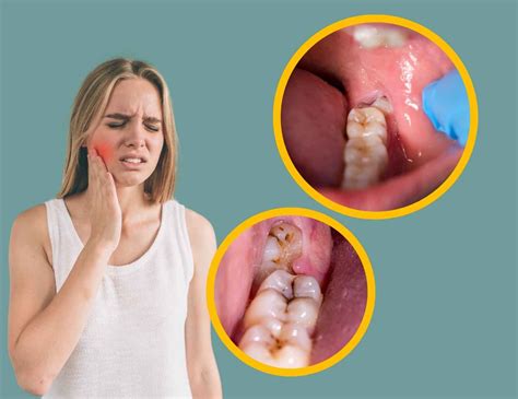 impacted wisdom teeth