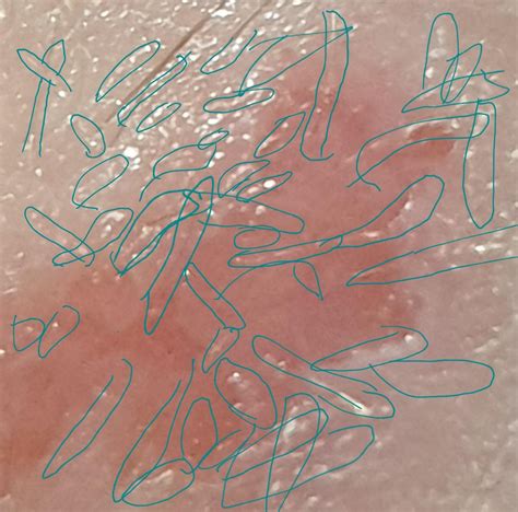 Vellus cysts and hair growing horizontal under skin : u/darkcallandra