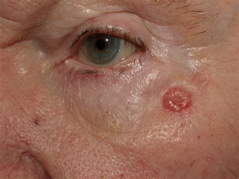 Basal Cell Carcinoma Stages Pictures at Gayla Wilson blog