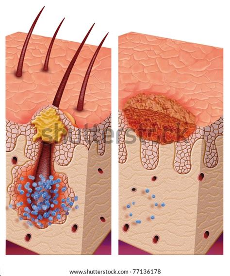 "Tinea barbae barbers itch" - 3 Ảnh, vector và hình chụp có sẵn ...