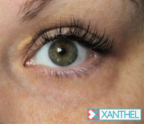 Xanthelasma Pictures - Xanthel