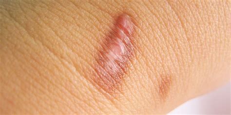 What Is A Keloid And How Do You Prevent Them?