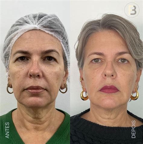 Platismoplastia Antes E Depois - Platismoplastia | Harmonização Facial | Dr. Fabio Barros | Rio de ...
