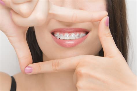 What to Expect in Your First Week with Braces | Rome Orthodontics