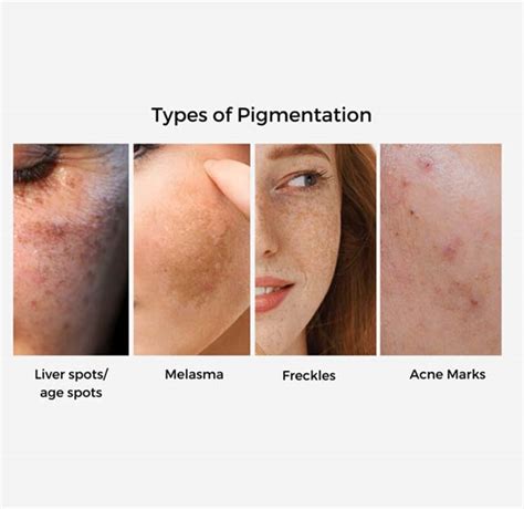 pigmentation treatment singapore target melasma dark spots